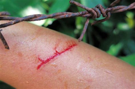Sintomas Ng Tetanus Na Kailangan Mong Bantayan Sa Mga Bata.